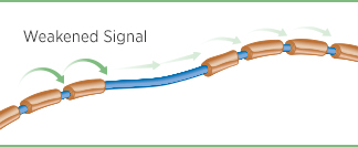 A damaged nerve with a broken down myelin layer as a result of MS